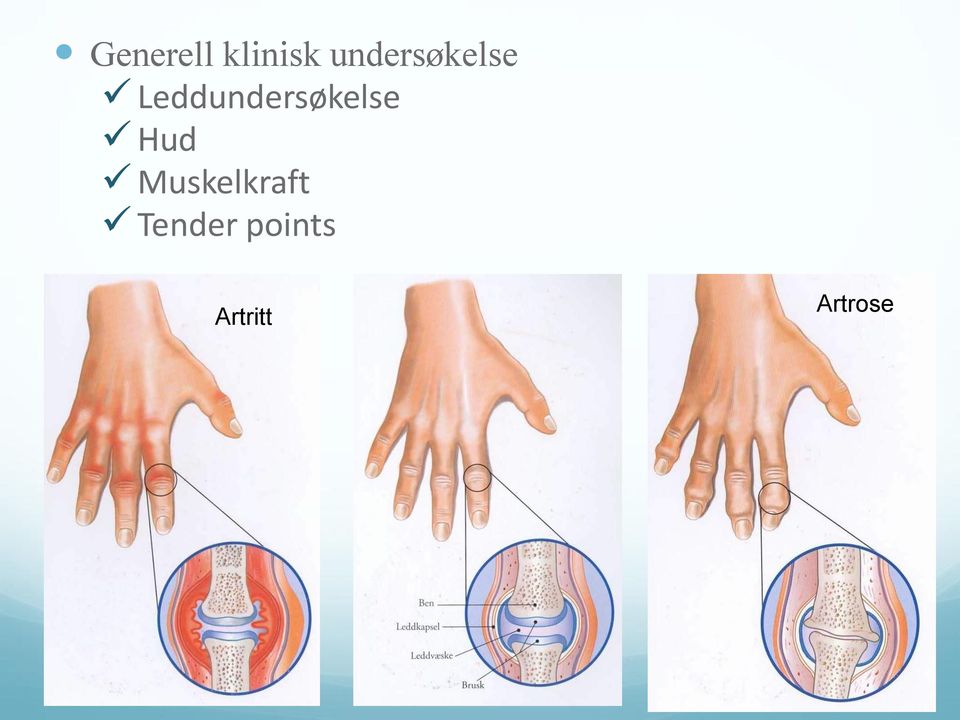 Muskelkraft Tender points