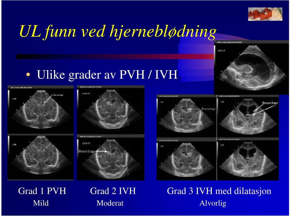 1 PVH Grad 2 IVH Grad 3 IVH