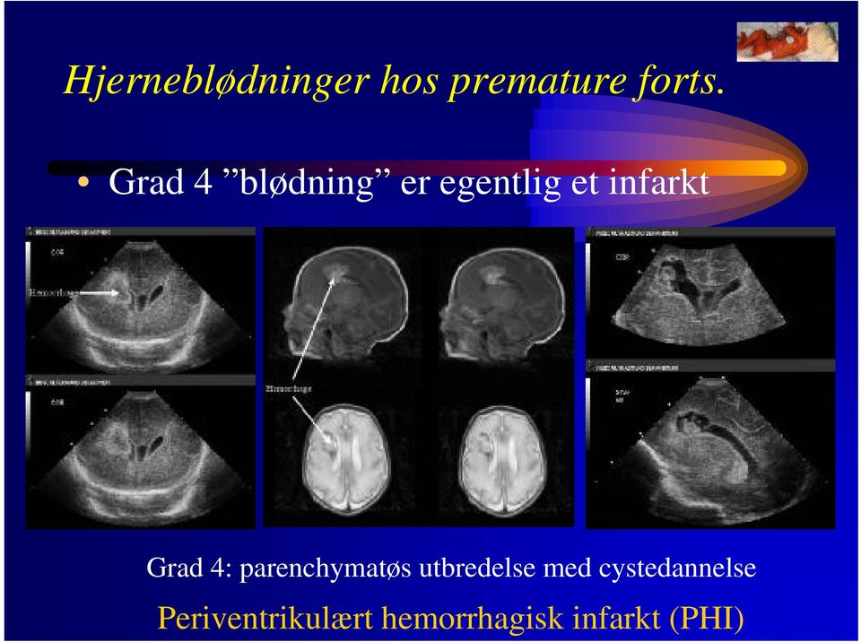 Grad 4: parenchymatøs utbredelse med