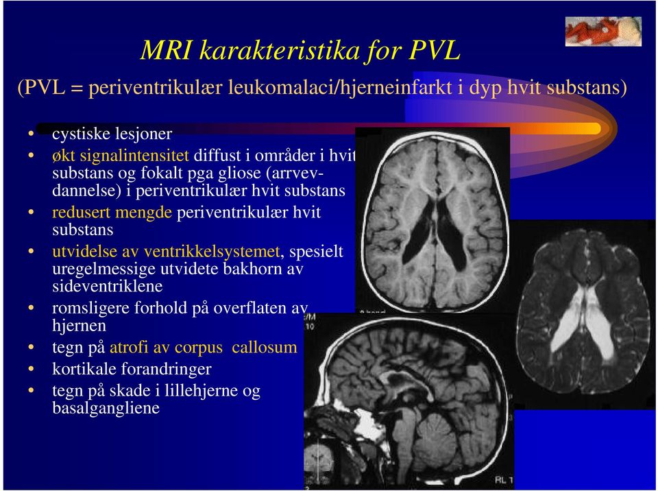 mengde periventrikulær hvit substans utvidelse av ventrikkelsystemet, spesielt uregelmessige utvidete bakhorn av sideventriklene