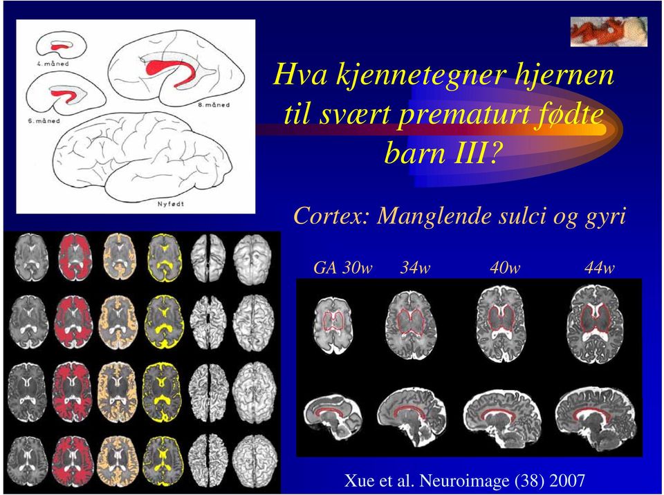 Cortex: Manglende sulci og gyri GA