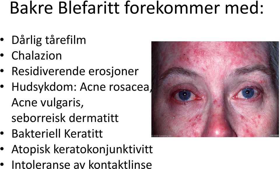 rosacea, Acne vulgaris, seborreisk dermatitt