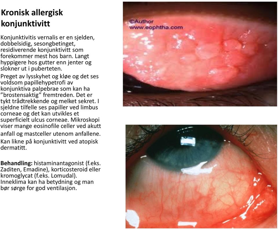 Det er tykt trådtrekkende og melket sekret. I sjeldne tilfelle ses papiller ved limbus corneae og det kan utvikles et superficielt ulcus corneae.