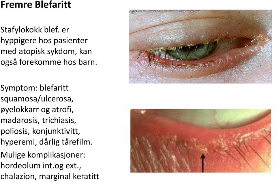 Symptom: blefaritt squamosa/ulcerosa, øyelokkarr og atrofi, madarosis,