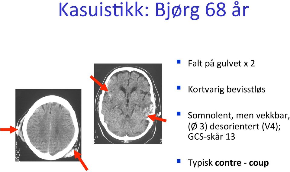 Somnolent, men vekkbar, (Ø 3)