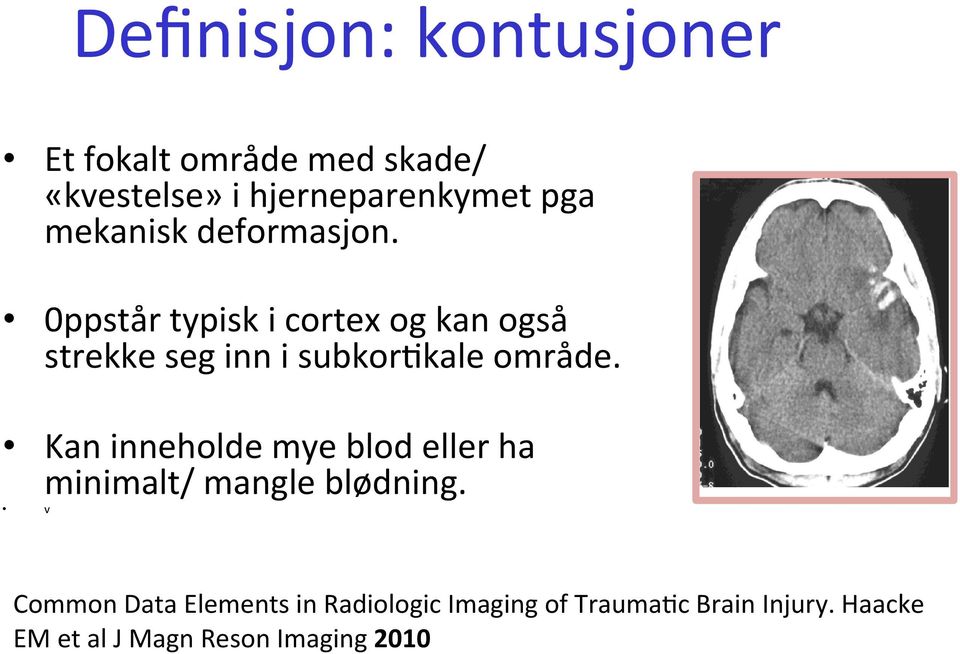 0ppstår typisk i cortex og kan også strekke seg inn i subkor:kale område.