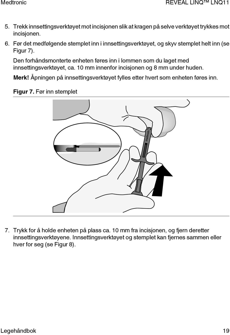 Den forhåndsmonterte enheten føres inn i lommen som du laget med innsettingsverktøyet, ca. 10 mm innenfor incisjonen og 8 mm under huden. Merk!