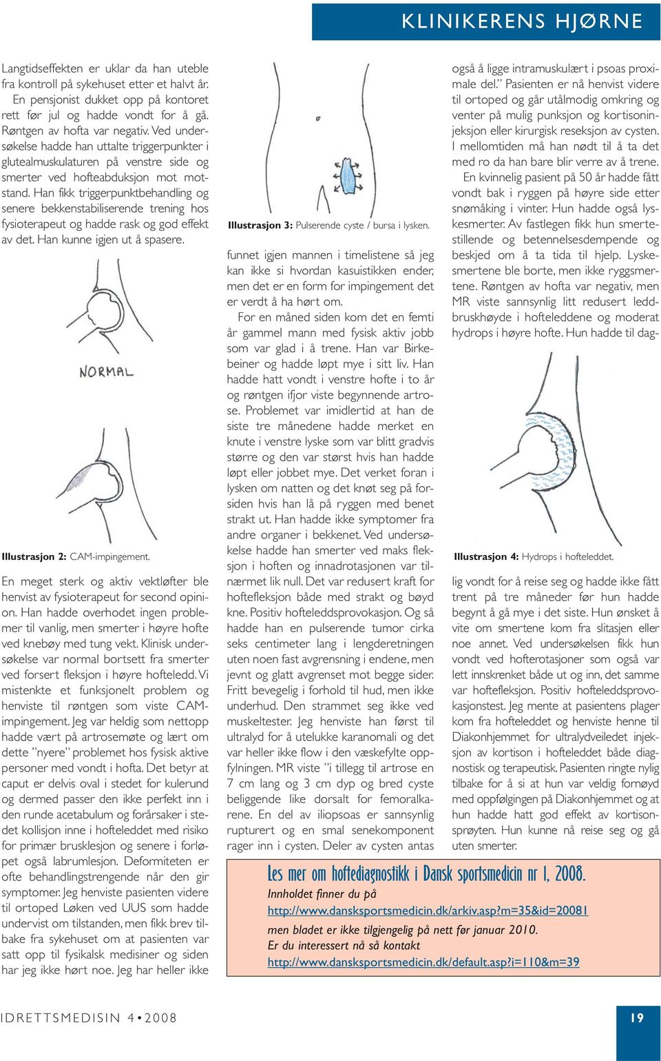 Han fikk triggerpunktbehandling og senere bekkenstabiliserende trening hos fysioterapeut og hadde rask og god effekt av det. Han kunne igjen ut å spasere. Illustrasjon 2: CAM-impingement.