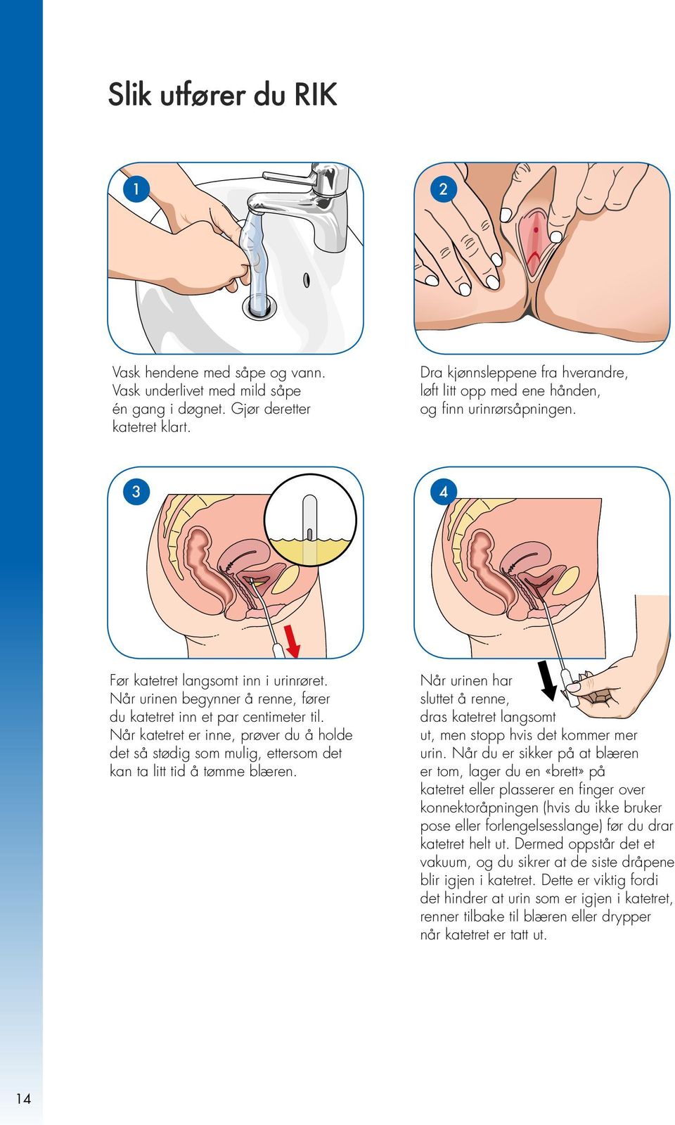 Når urinen begynner å renne, fører du katetret inn et par centimeter til. Når katetret er inne, prøver du å holde det så stødig som mulig, ettersom det kan ta litt tid å tømme blæren.