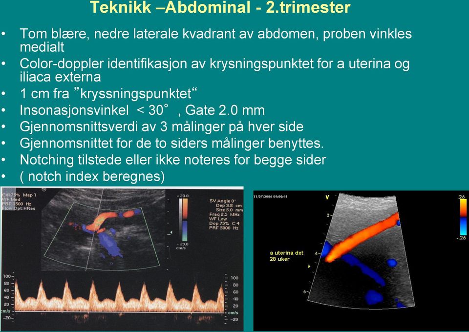 identifikasjon av krysningspunktet for a uterina og iliaca externa 1 cm fra kryssningspunktet