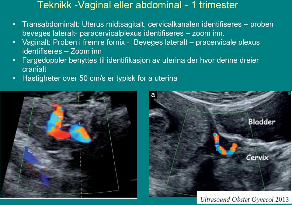 Vaginalt: Proben i fremre fornix - Beveges lateralt pracervicale plexus identifiseres Zoom inn