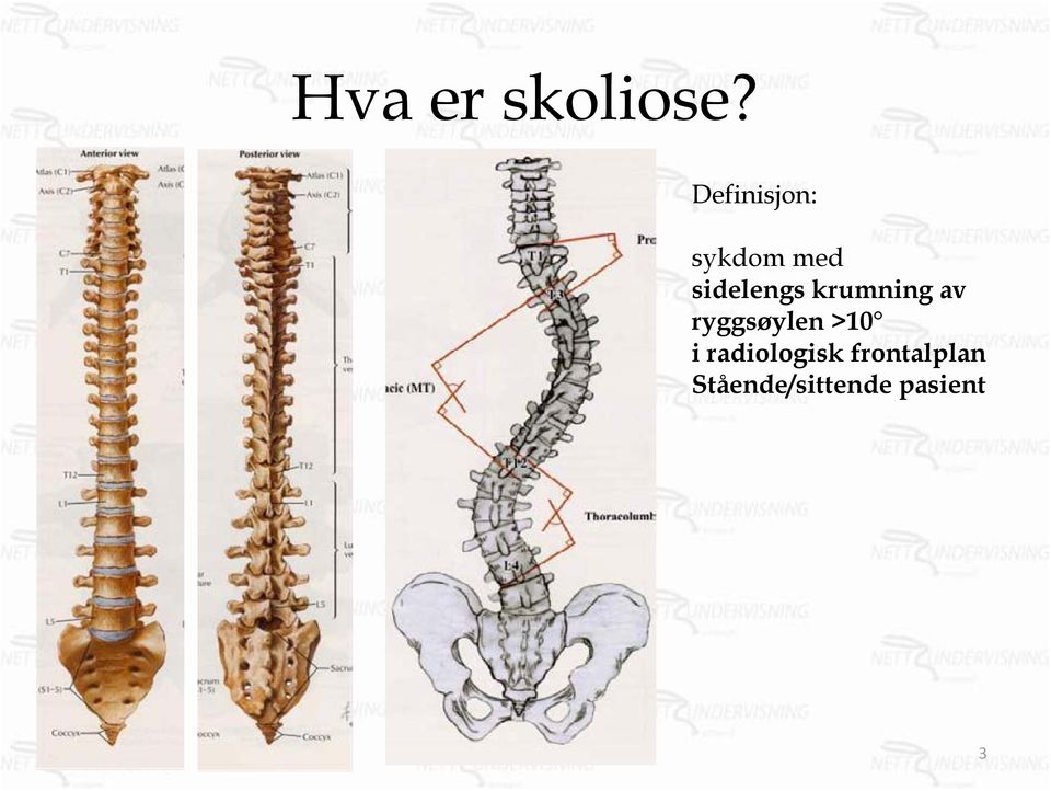 krumning av ryggsøylen >10 i