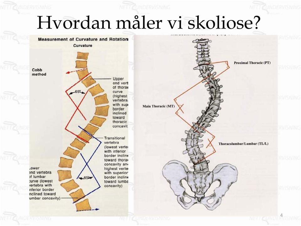 skoliose?