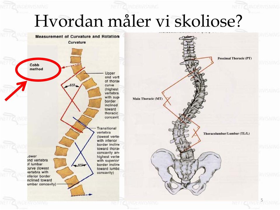 skoliose?