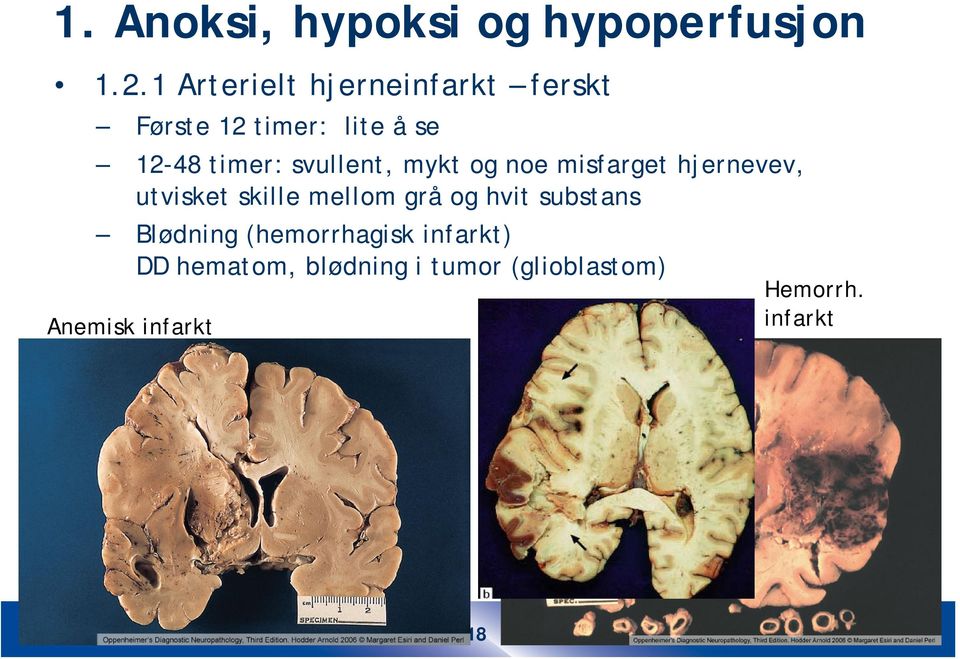 svullent, mykt og noe misfarget hjernevev, utvisket skille mellom grå og hvit