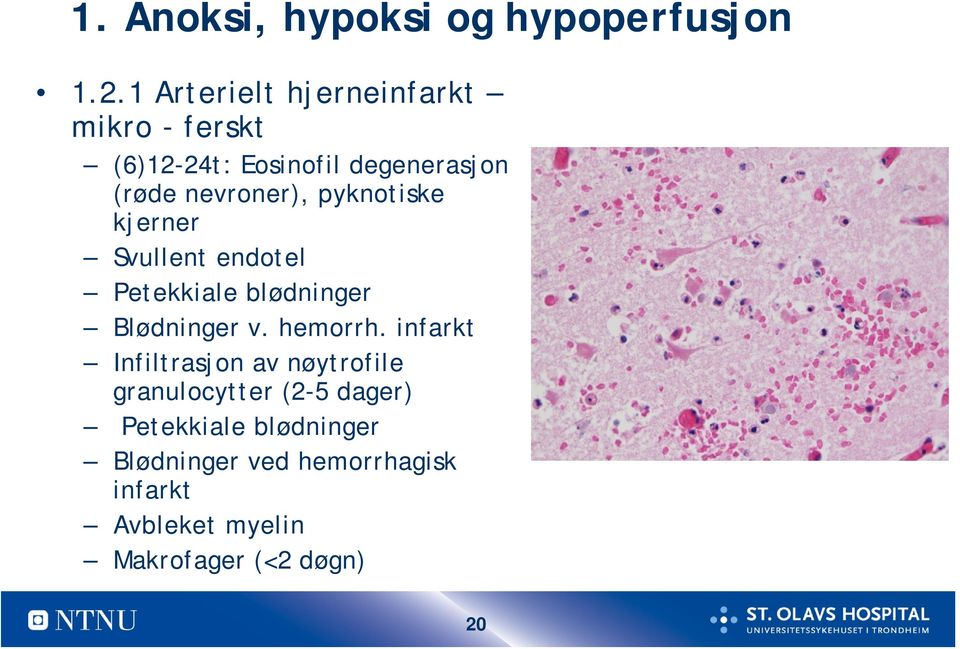 pyknotiske kjerner Svullent endotel Petekkiale blødninger Blødninger v. hemorrh.