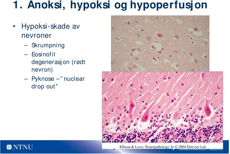 nevroner Skrumpning Eosinofil