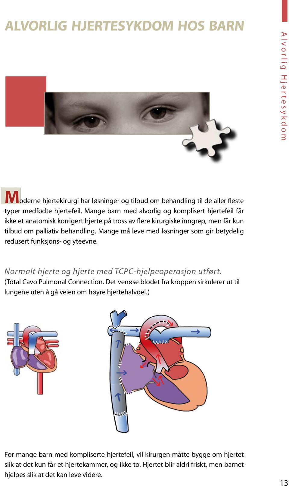 Mange må leve med løsninger som gir betydelig redusert funksjons- og yteevne. Nor malt hjerte og hjerte med TCPC-hjelpeoperasjon utført. (Total Cavo Pulmonal Connection.