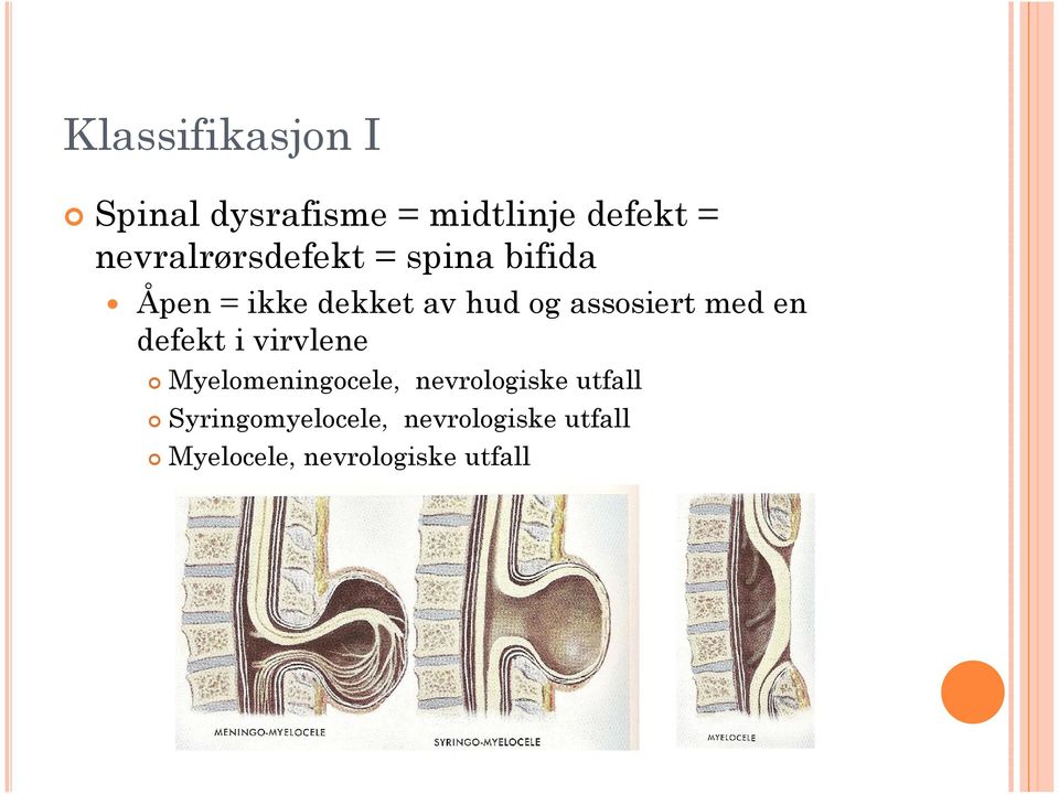 assosiert med en defekt i virvlene Myelomeningocele,