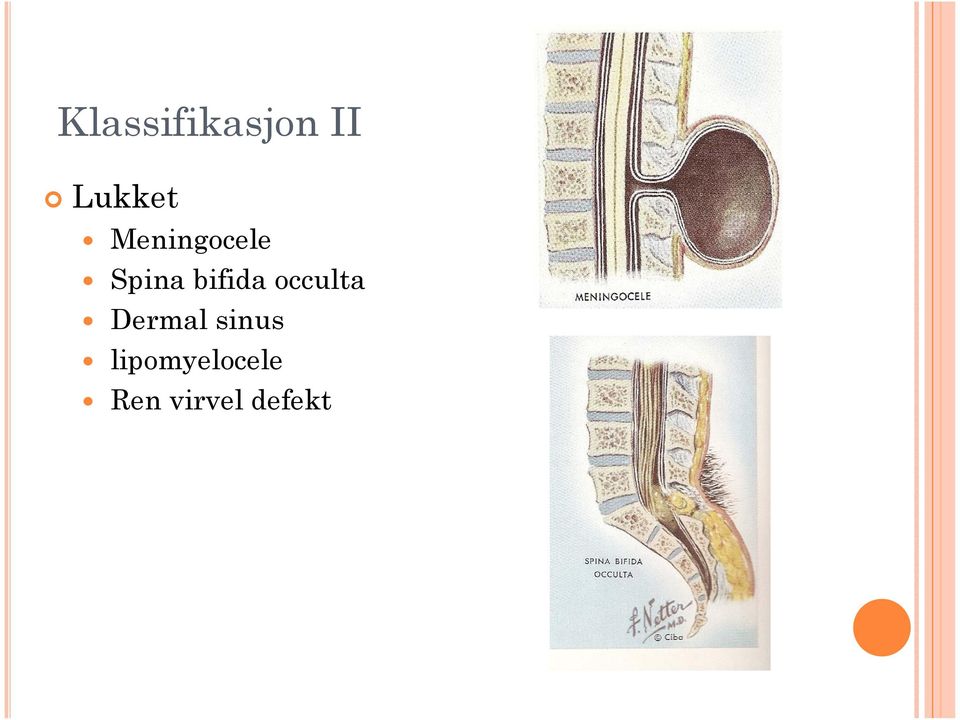 occulta Dermal sinus