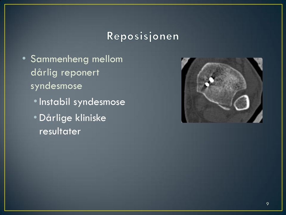 syndesmose Instabil