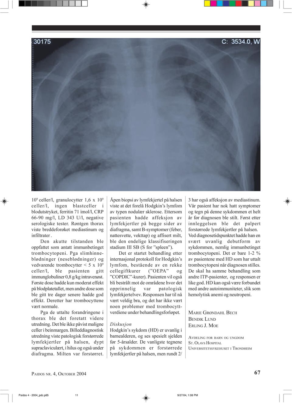 pasienten gitt immunglobuliner 0,8 g/kg intravenøst Første dose hadde kun moderat effekt på blodplatetallet, men andre dose som ble gitt tre dager senere hadde god effekt Deretter har trombocyttene