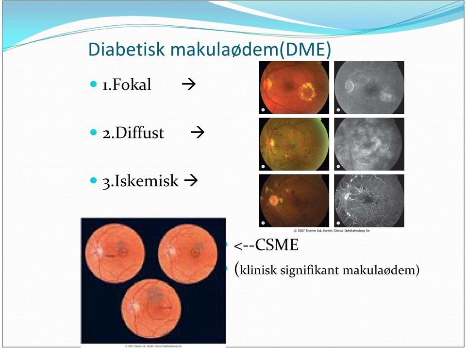 Fokal 2.Diffust 3.