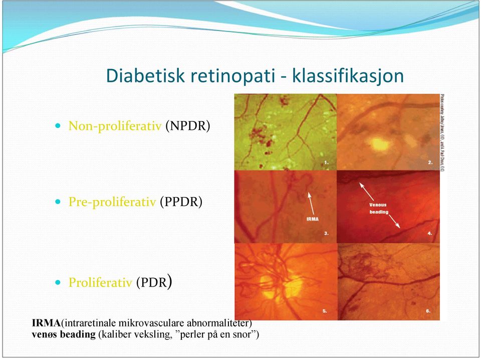 Proliferativ (PDR) IRMA(intraretinale