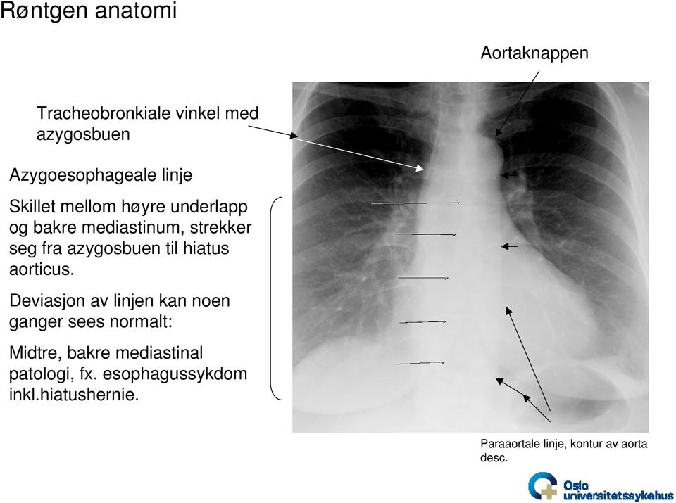 til hiatus aorticus.