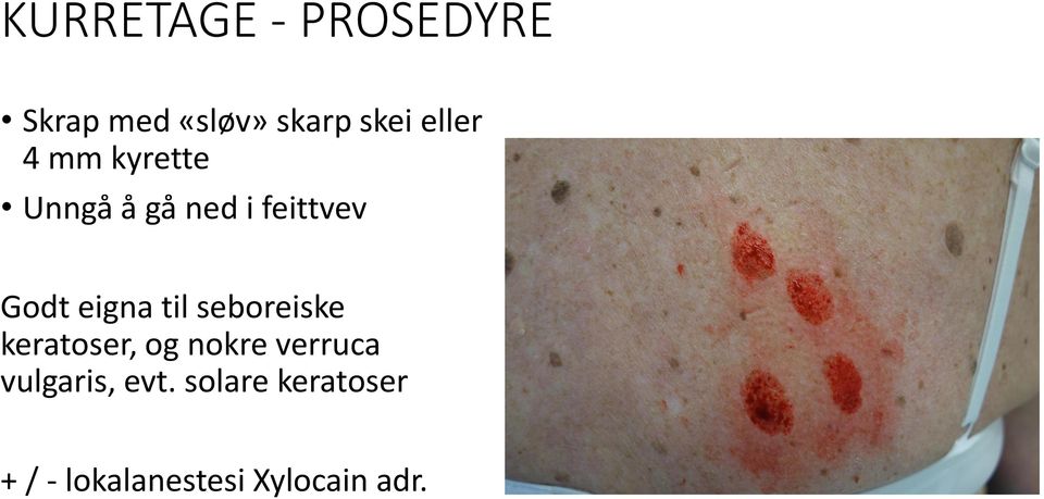 eigna til seboreiske keratoser, og nokre verruca