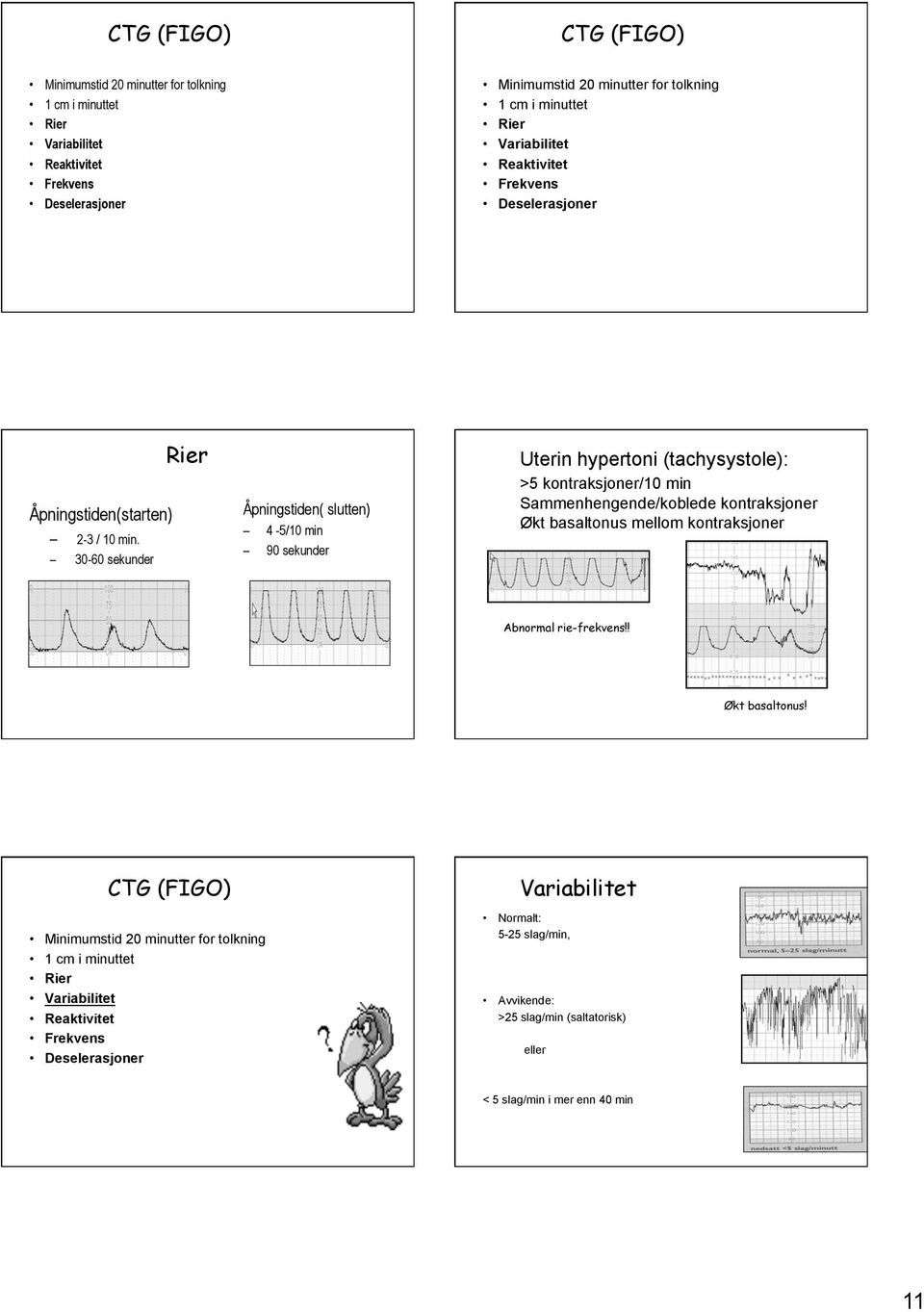 30-60 sekunder Rier Åpningstiden( slutten) 4-5/10 min 90 sekunder Uterin hypertoni (tachysystole): >5 kontraksjoner/10 min Sammenhengende/koblede kontraksjoner Økt basaltonus mellom