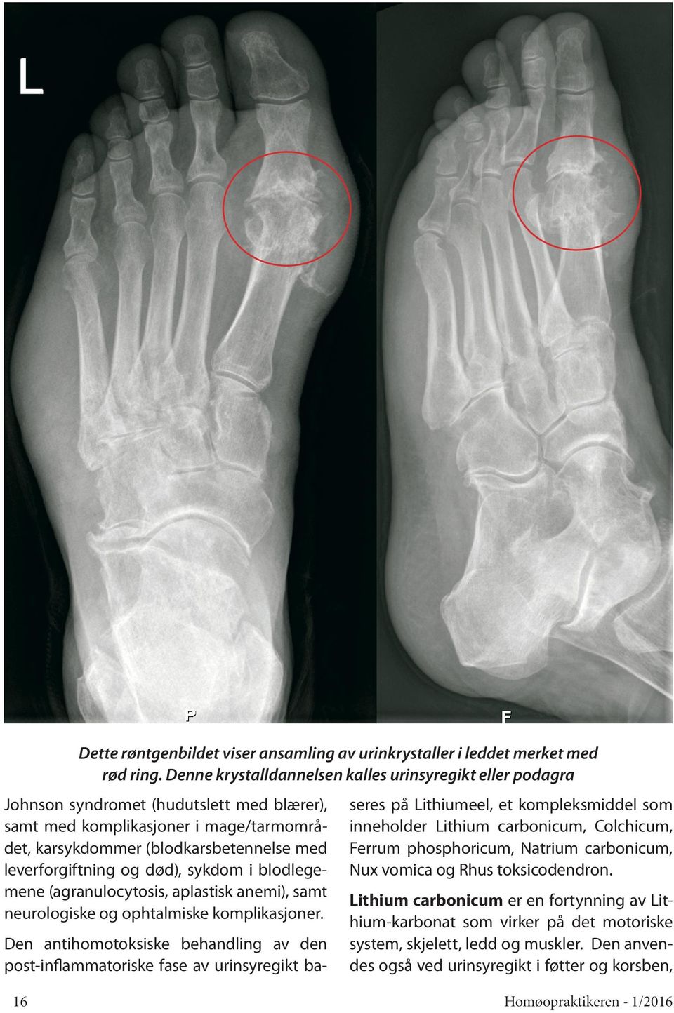 og død), sykdom i blodlegemene (agranulocytosis, aplastisk anemi), samt neurologiske og ophtalmiske komplikasjoner.