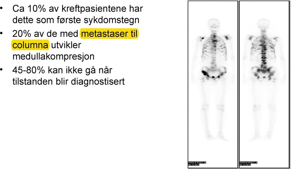 til columna utvikler medullakompresjon