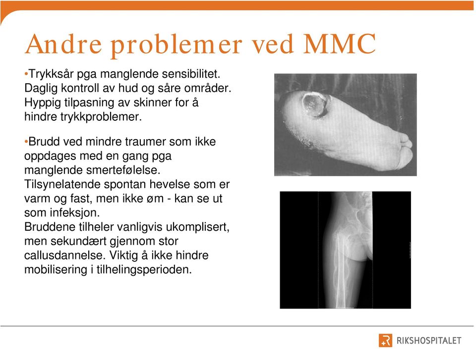 Brudd ved mindre traumer som ikke oppdages med en gang pga manglende smertefølelse.