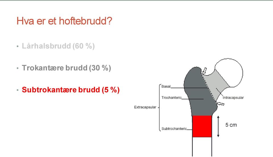 Trokantære brudd (30 %)