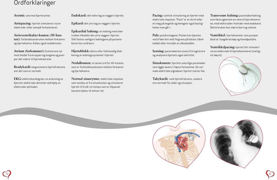 Transvenøs ledning: pacemakerledning som føres gjennom en vene til hjertekamrene, med elektroden i kontakt med endokard. Dette brukes hos større barn og voksne.