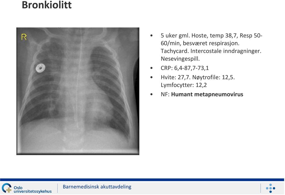 Tachycard. Intercostale inndragninger. Nesevingespill.