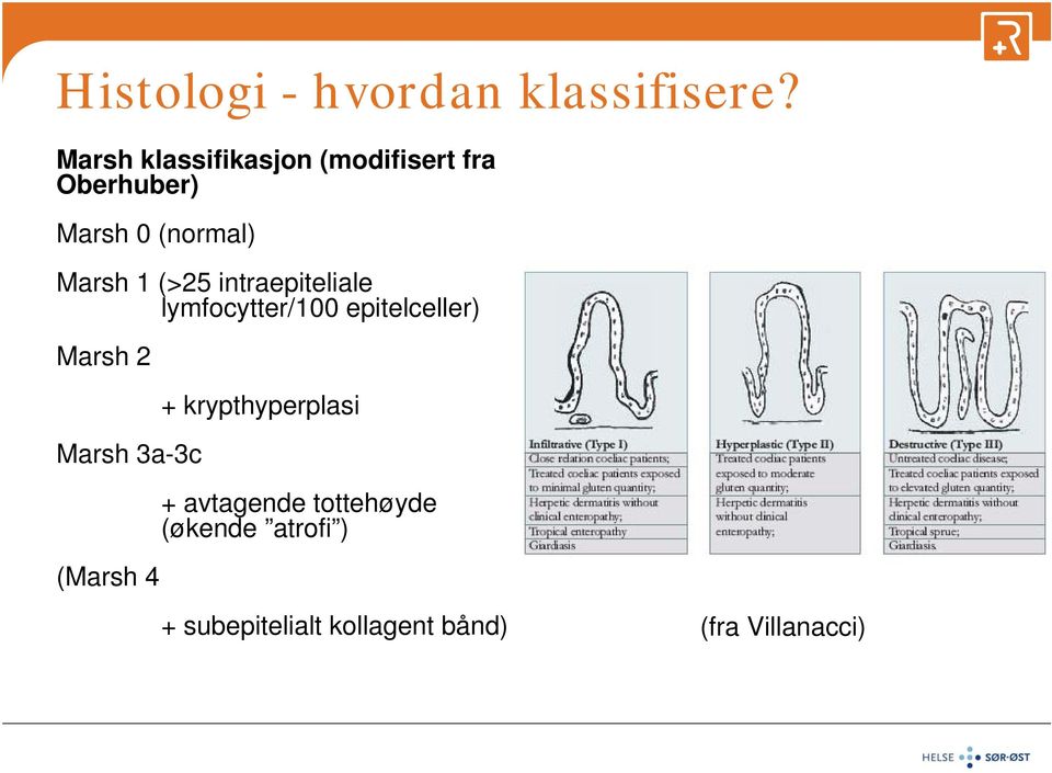 (>25 intraepiteliale lymfocytter/100 epitelceller) Marsh 2 Marsh 3a-3c