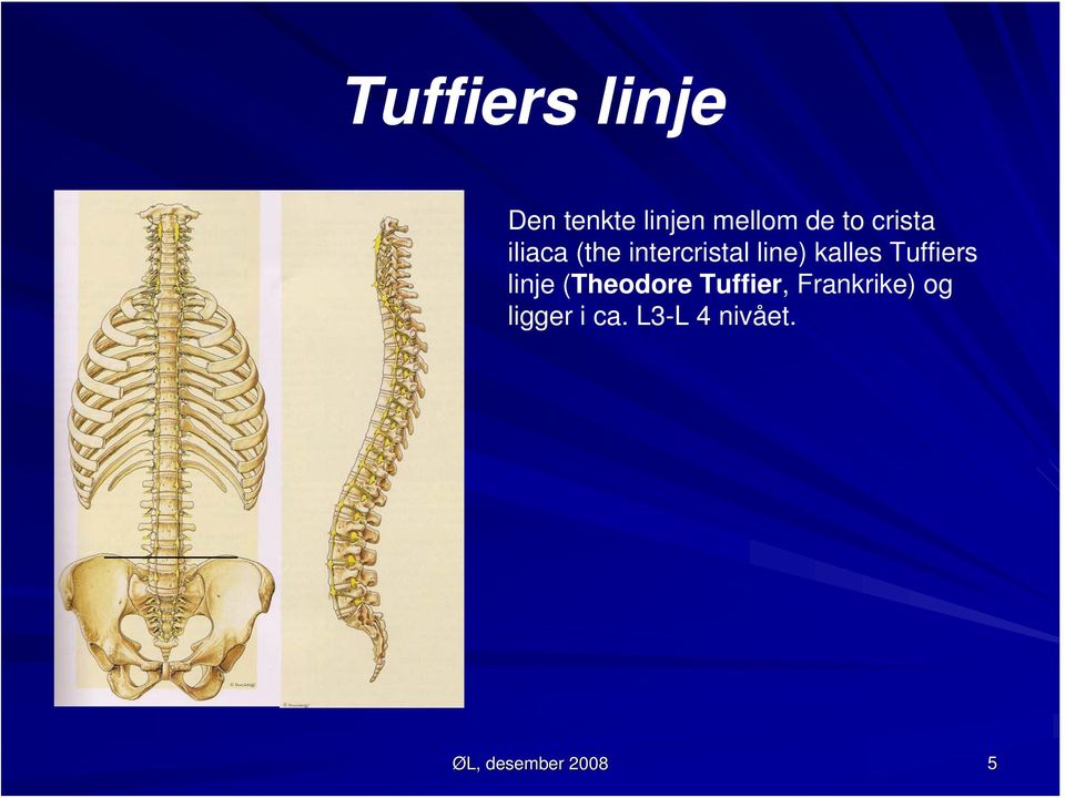 Tuffiers linje (Theodore Tuffier, Frankrike)