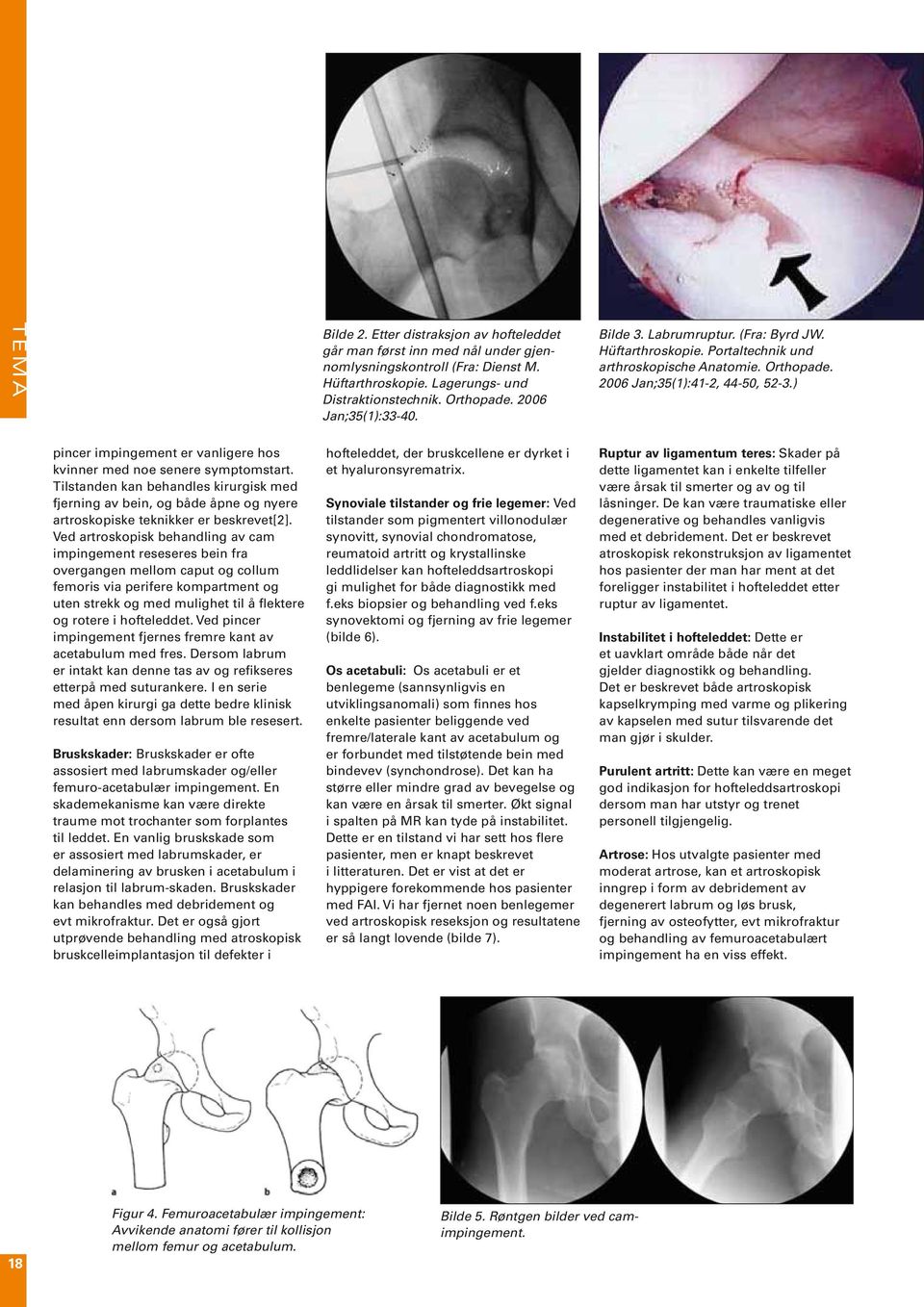 ) pincer impingement er vanligere hos kvinner med noe senere symptomstart. Tilstanden kan behandles kirurgisk med fjerning av bein, og både åpne og nyere artroskopiske teknikker er beskrevet[2].