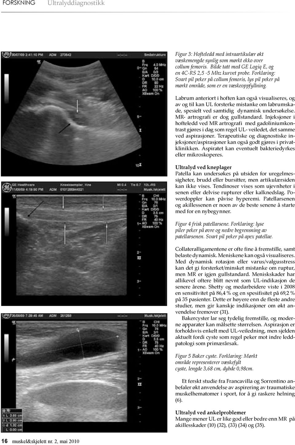 Labrum anteriort i hoften kan også visualiseres, og av og til kan UL forsterke mistanke om labrumskade, spesielt ved samtidig dynamisk undersøkelse. MR- artrografi er dog gullstandard.