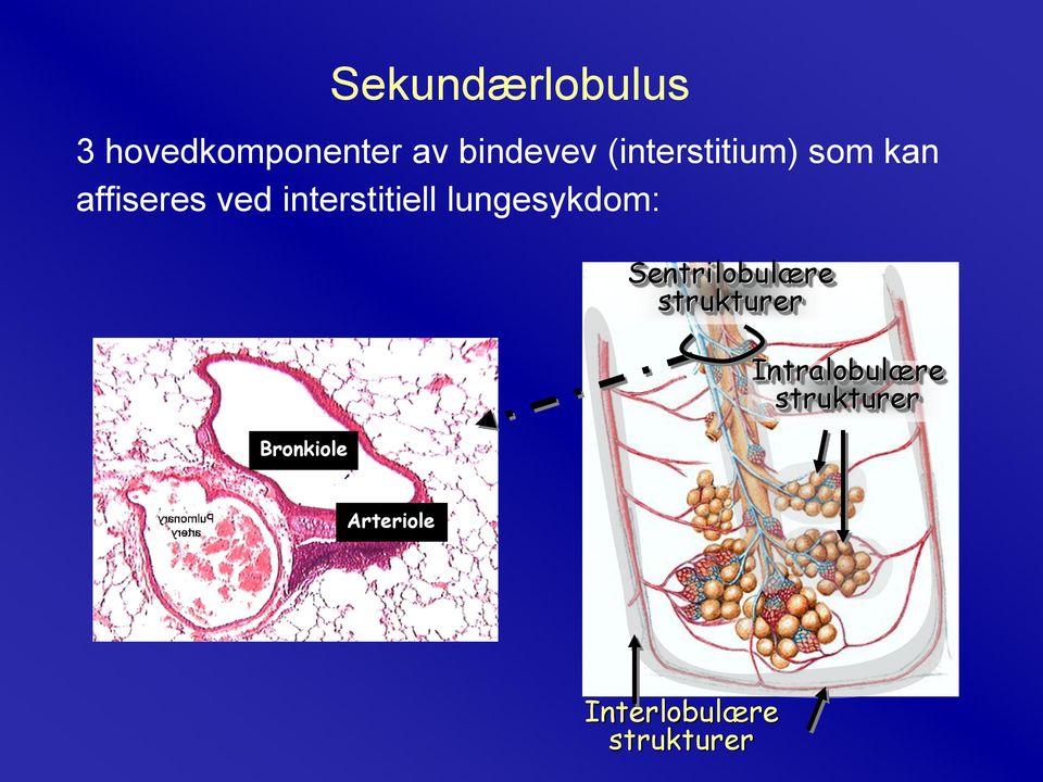 lungesykdom: Bronkiole Sentrilobulære strukturer