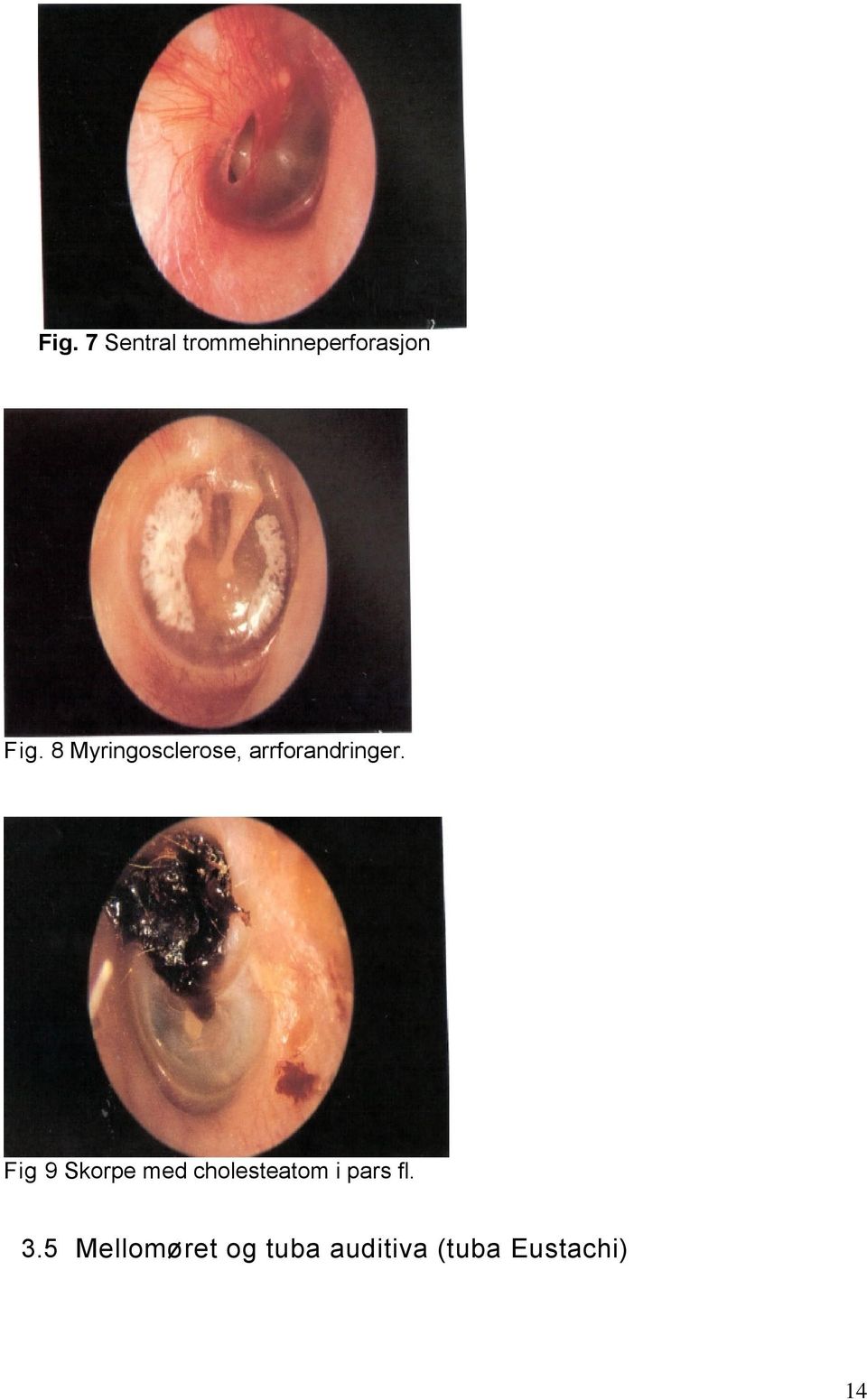 Fig 9 Skorpe med cholesteatom i pars fl. 3.