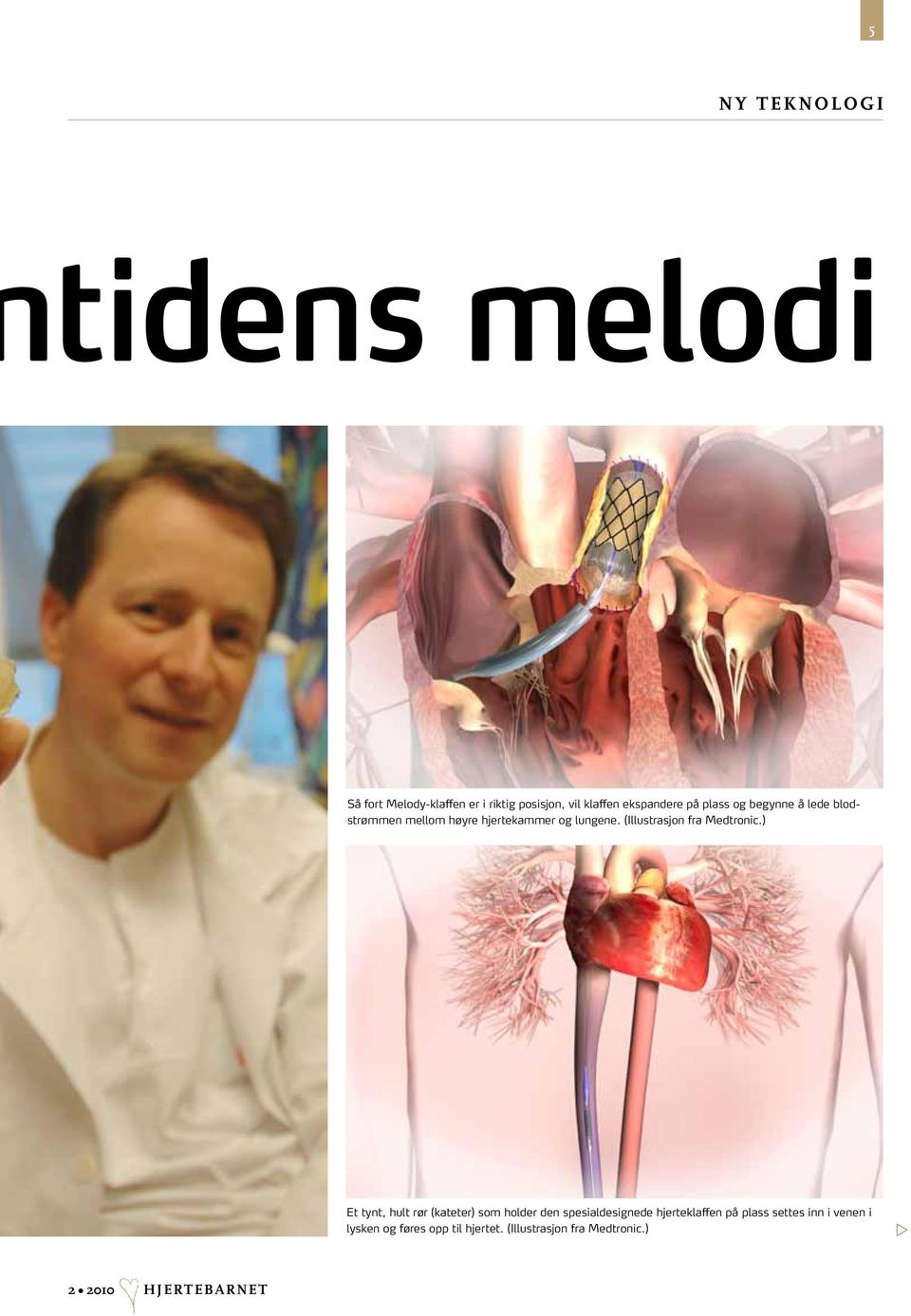 (Illustrasjon fra Medtronic.