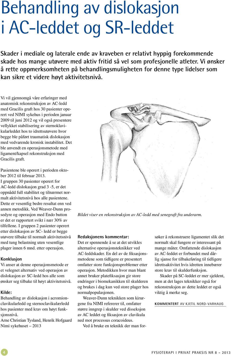 Vi vil gjennomgå våre erfaringer med anatomisk rekonstruksjon av AC-ledd med Gracilis graft hos 30 pasienter operert ved NIMI sykehus i perioden januar 2009 til juni 2012 og vil også presentere