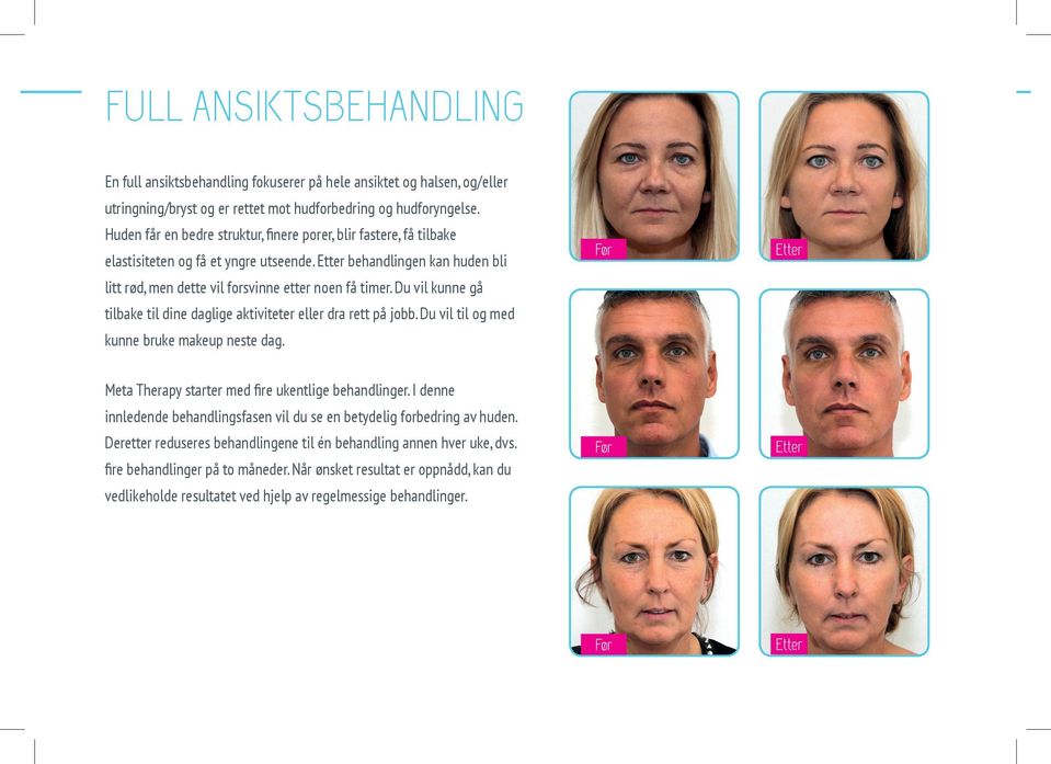 Du vil kunne gå tilbake til dine daglige aktiviteter eller dra rett på jobb. Du vil til og med kunne bruke makeup neste dag. Før Etter Meta Therapy starter med fire ukentlige behandlinger.