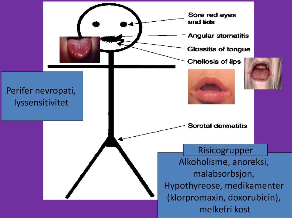 malabsorbsjon, Hypothyreose,