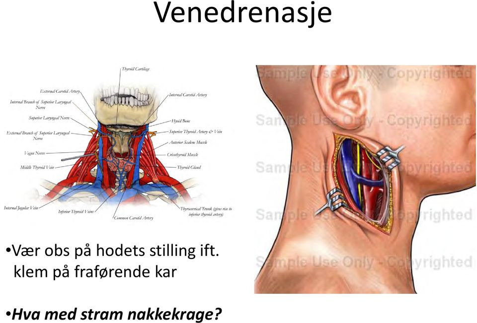 klem på fraførende kar