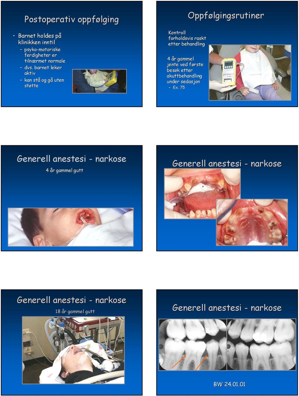 Ex. 75 Oppfølgingsrutiner Kontroll forholdsvis raskt etter behandling Generell anestesi - narkose 4 år gammel gutt