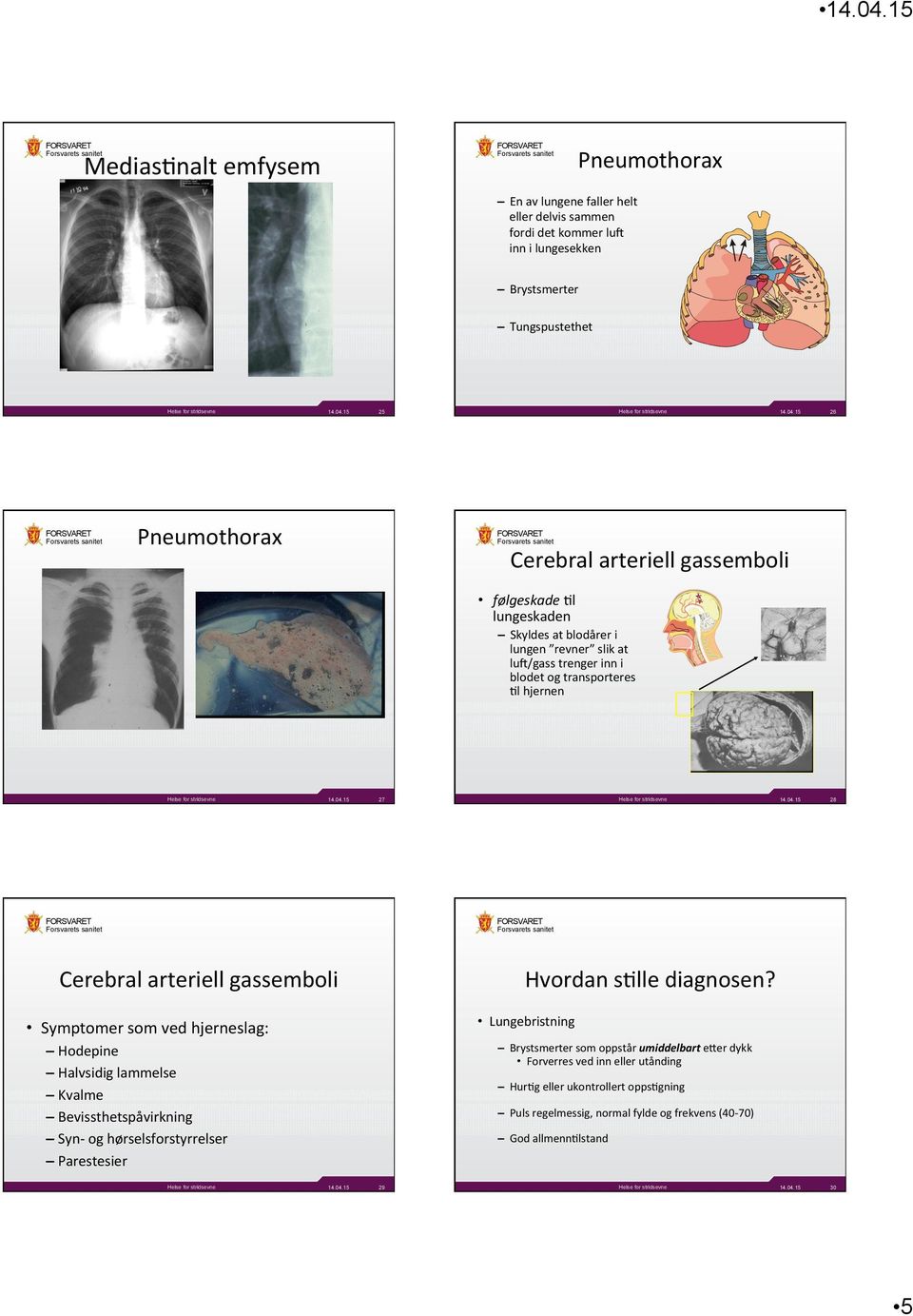 gassemboli Symptomer som ved hjerneslag: Hodepine Halvsidig lammelse Kvalme Bevissthetspåvirkning Syn- og hørselsforstyrrelser Parestesier Hvordan s:lle diagnosen?